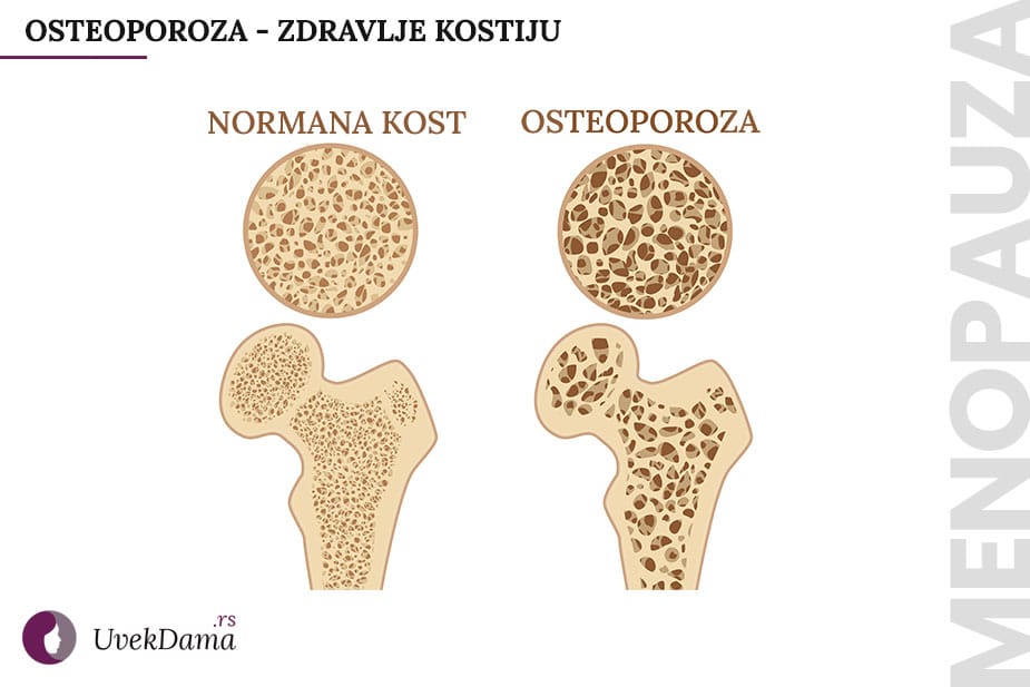 Osteoporoza u menopauzi - ilustracija izgleda kostiju