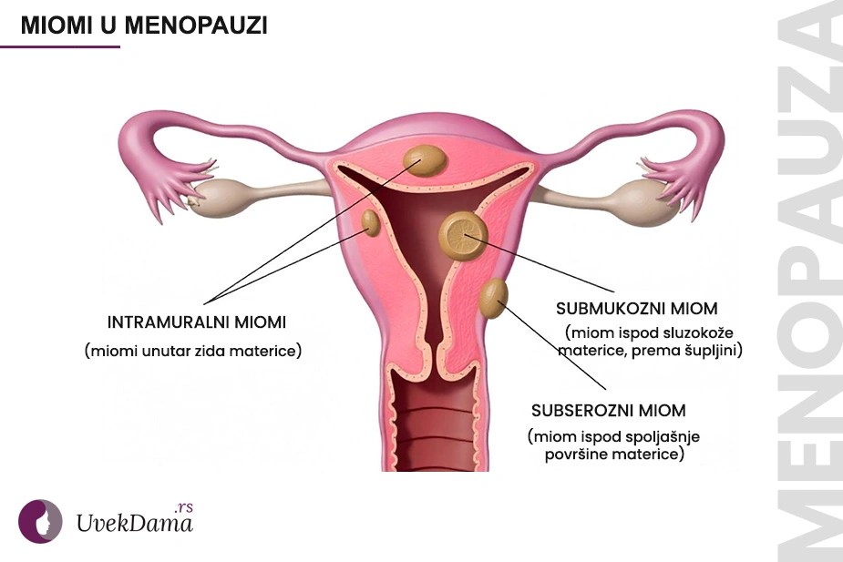Ilustracija materice sa prikazanim intramuralnim (unutar zida), submukoznim (ispod sluzokože) i subseroznim (ispod spoljašnje površine) miomima.