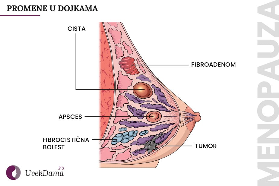 Promene u dojkama - ilustraciju za displaziju dojke